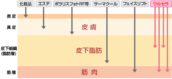 ウルセラ