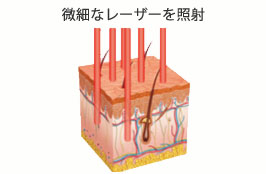 微細なレーザー照射