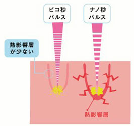 ピコレーザーの仕組み