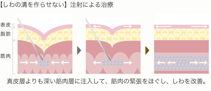 しわの溝を作らせない