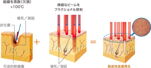 フラクショナルレーザーの仕組み