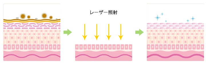 シャイニングピールの仕組み