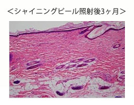 シャイニングピール照射後3ヶ月