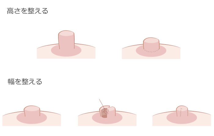 乳頭の高さや幅を整える