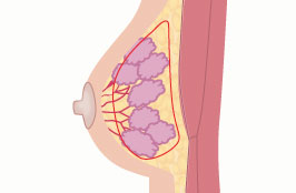 偽性女性化乳房