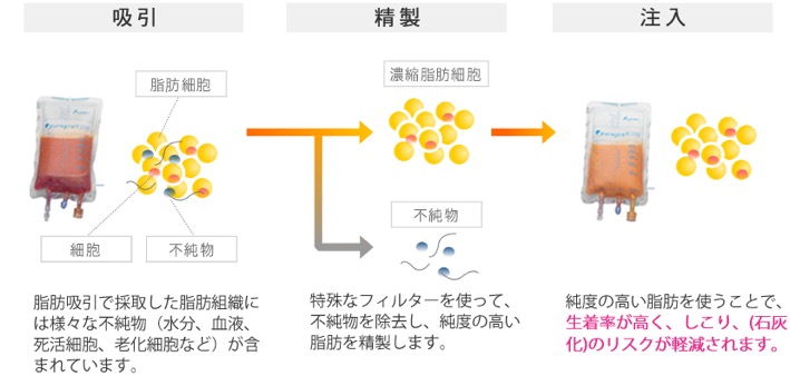 吸引から注入まで