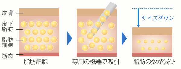 脂肪吸引の説明