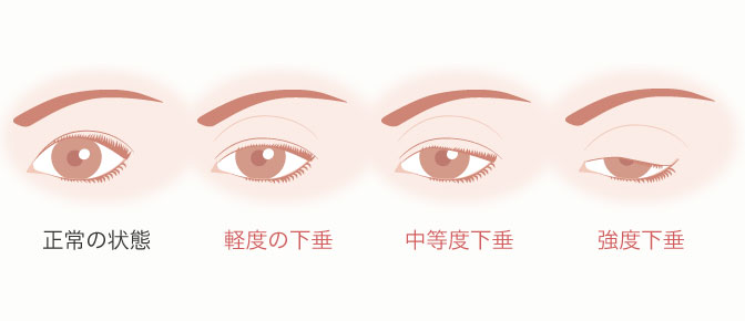 眼瞼下垂の程度