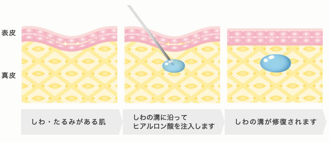 ヒアルロン酸注入