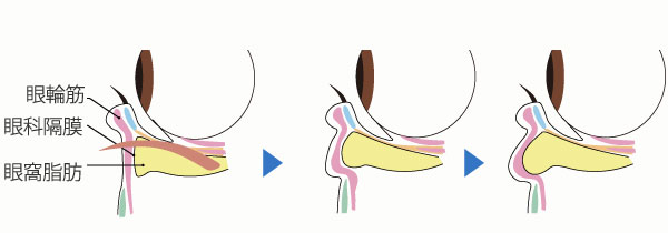 目の下のたるみの進行