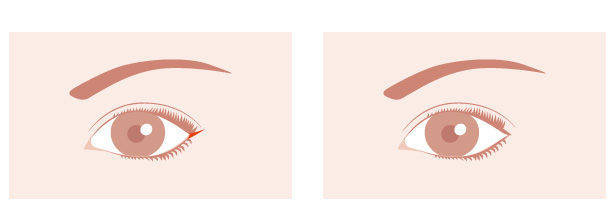 目尻切開の治療説明