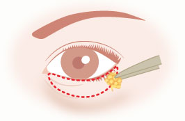 下まぶたの脂肪除去