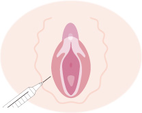 大陰唇が痩せてしまう