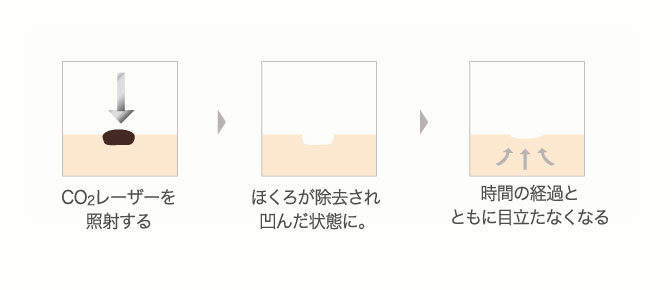 炭酸ガスレーザーによる治療