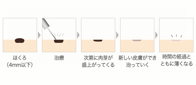 電気分解法による治療