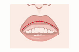 上唇縮小手術2
