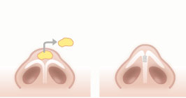鼻尖の脂肪除去