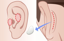 耳介軟骨移植