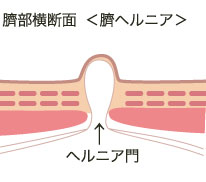 臍ヘルニア