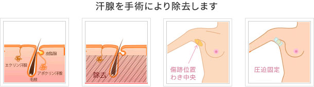 汗腺を手術により除去